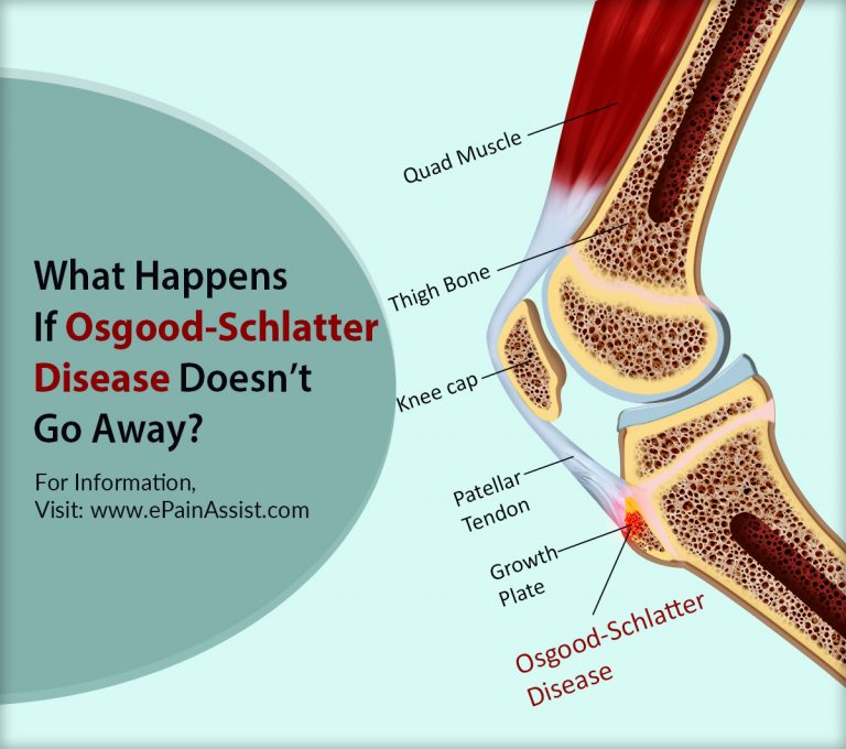 What Happens If Osgood-Schlatter Disease Doesn’t Go Away & When To Go To Doctor?