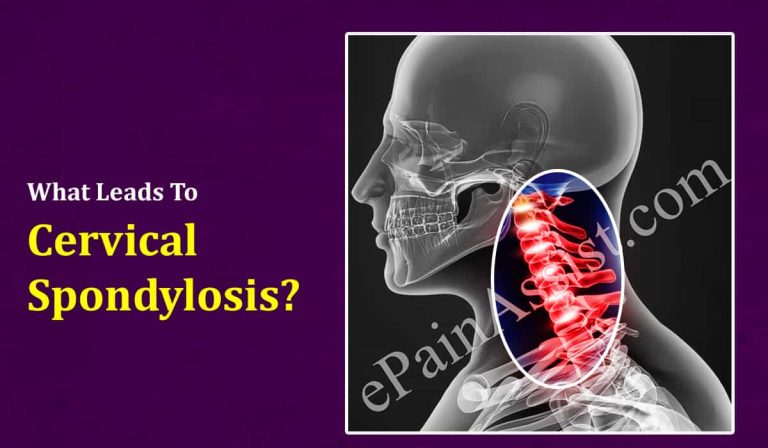 What Leads To Cervical Spondylosis & Can It Be Cured?