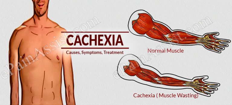 What is Cachexia: Causes, Symptoms, Treatment, Prevention