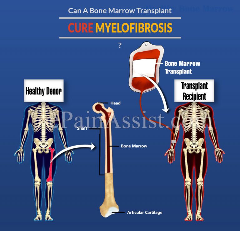 Can A Bone Marrow Transplant Cure Myelofibrosis?
