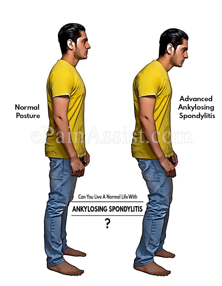 Can You Live A Normal Life With Ankylosing Spondylitis?