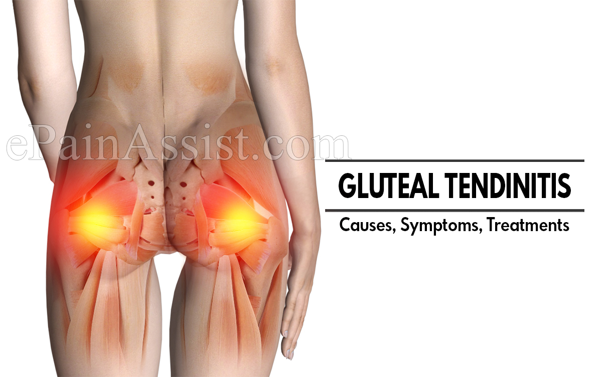 What is Gluteal Tendinitis: Causes, Symptoms, Treatments, Exercises, Prevention