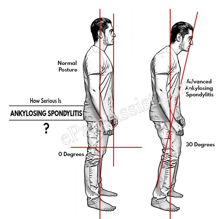 How Serious Is Ankylosing Spondylitis & Does Ankylosing Spondylitis Reduce Life Expectancy?