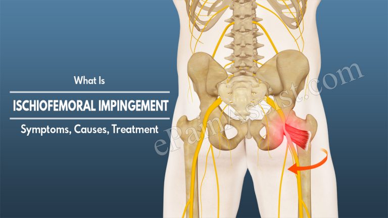 Ischiofemoral Impingement: Symptoms, Causes, Warning Signs, Treatment