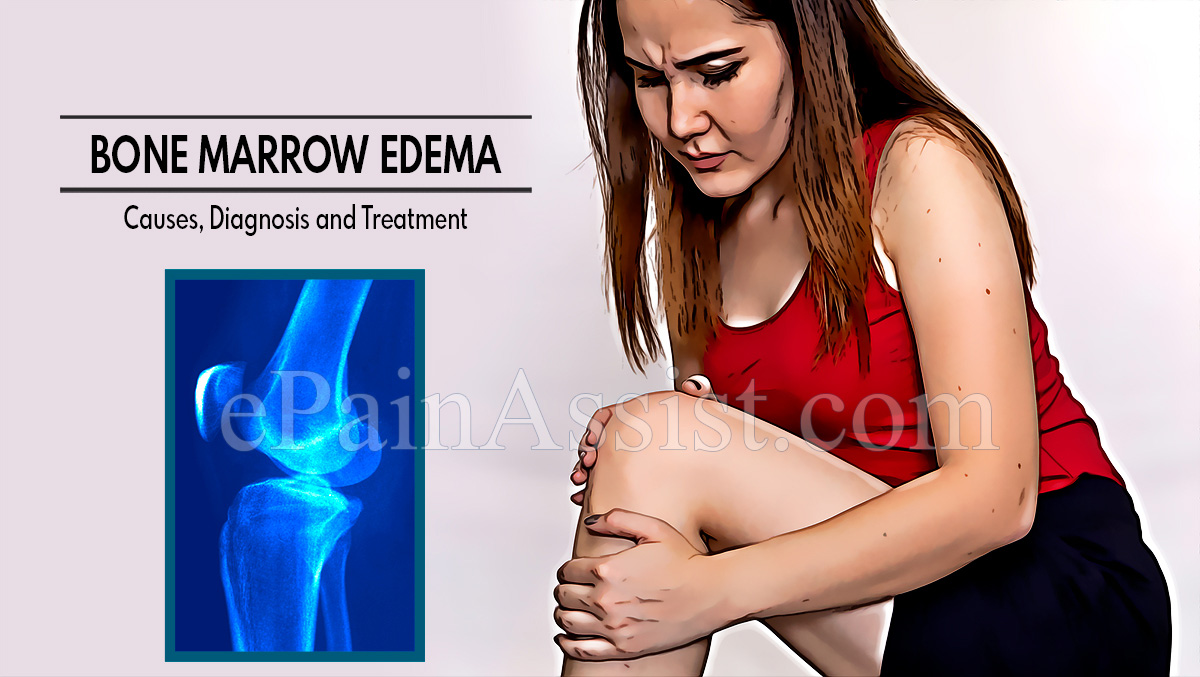 Understanding Bone Marrow Edema, Its Causes, Diagnosis and Treatment