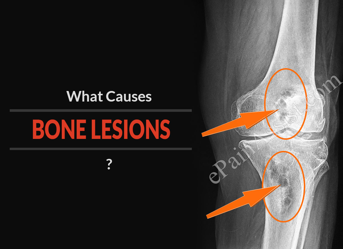 What Causes Bone Lesions and How to Treat Them?