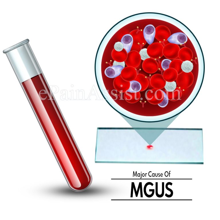 What Is The Major Cause Of MGUS Or Monoclonal Gammopathy Of Undetermined Significance?