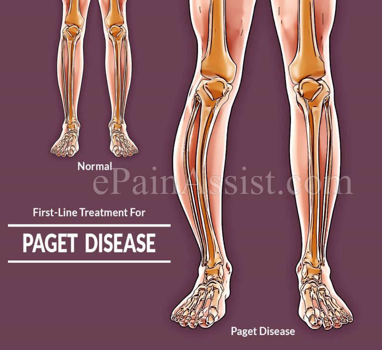 Which Is The First-Line Treatment For Paget Disease & What Is The Best Treatment For It?