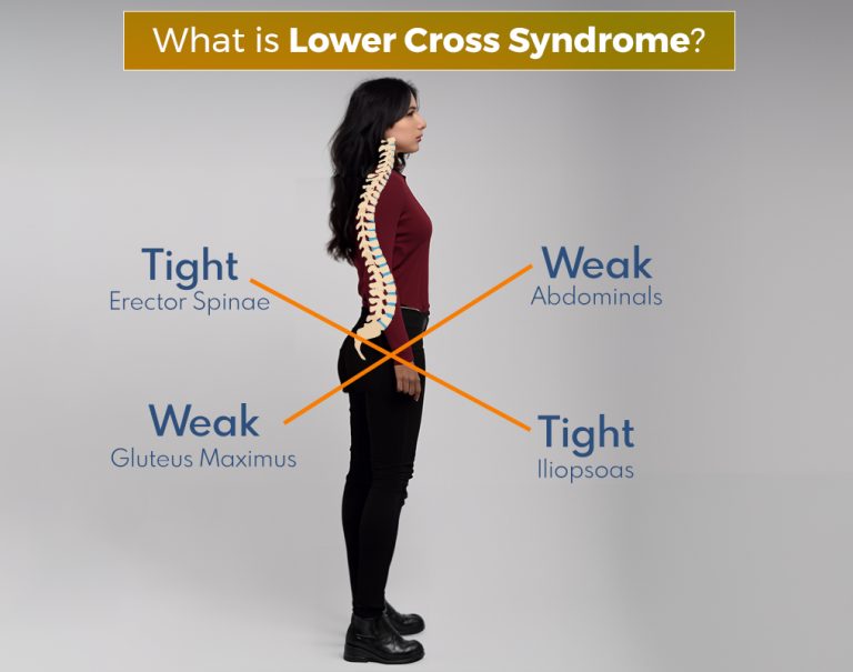 Lower Cross Syndrome: Causes, Symptoms, Treatment