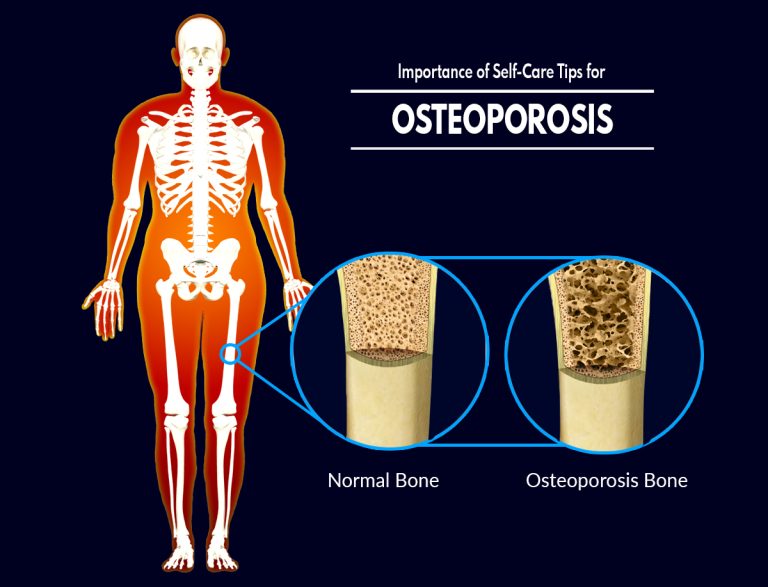 Managing Osteoporosis : Essential Self-Care Tips for Better Bone Health