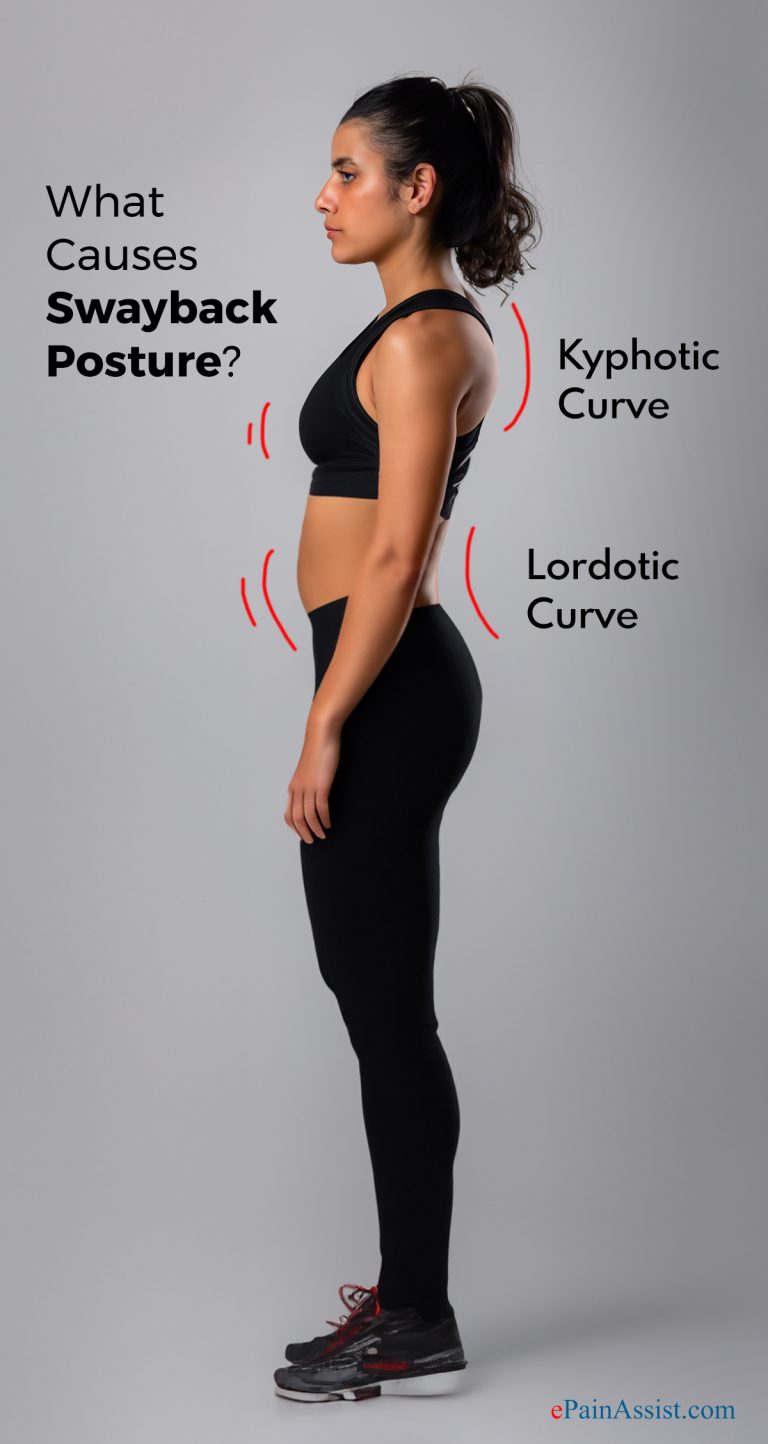 What Causes Swayback Posture & What are Its Treatment, Exercises?
