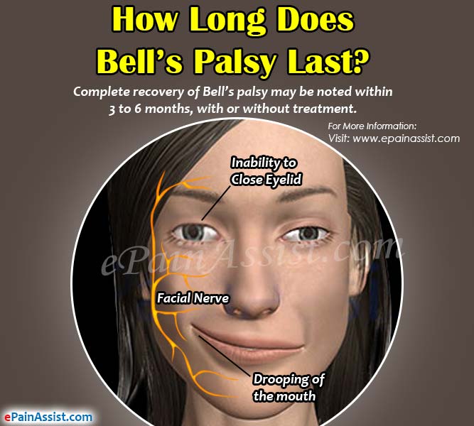 How Long Does Bell S Palsy Last What Are Its Recovery Signs