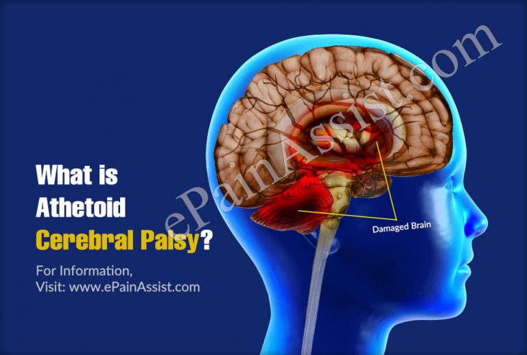 Athetoid Cerebral Palsy: Causes, Symptoms, Treatment, Classification