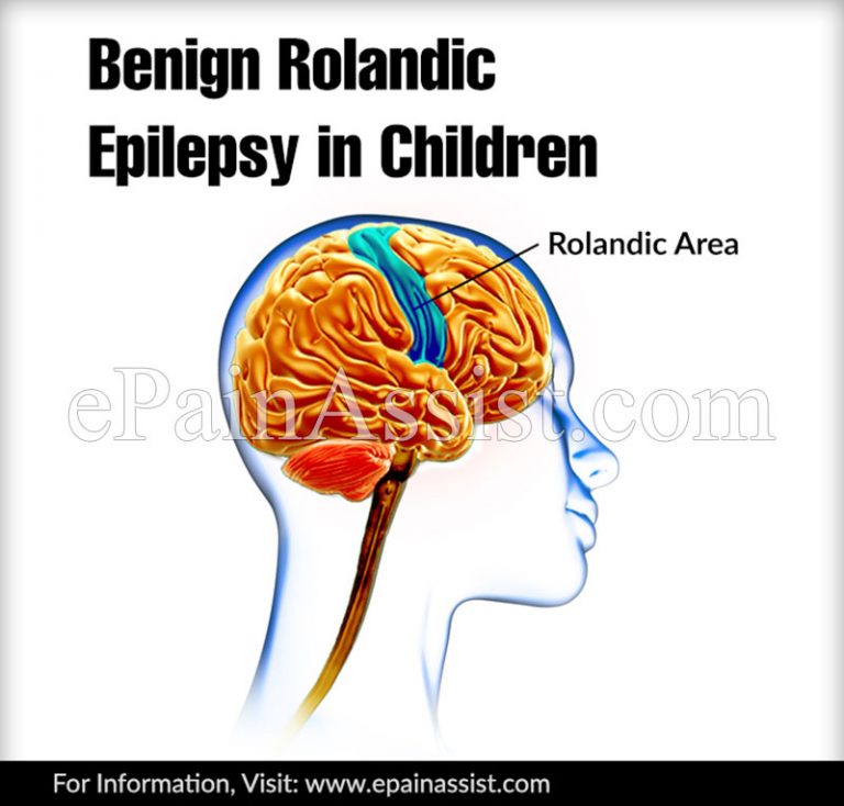Benign Rolandic Epilepsy: Causes, Symptoms, Treatment, Prognosis