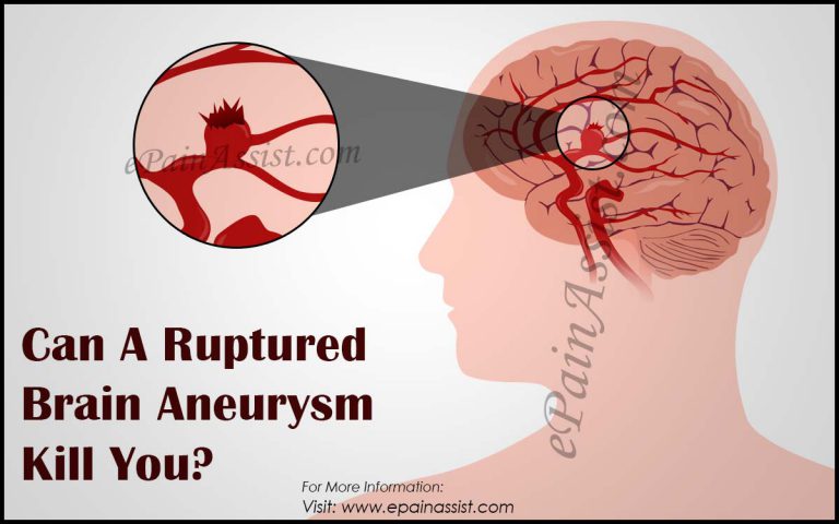 Can A Ruptured Brain Aneurysm Kill You?