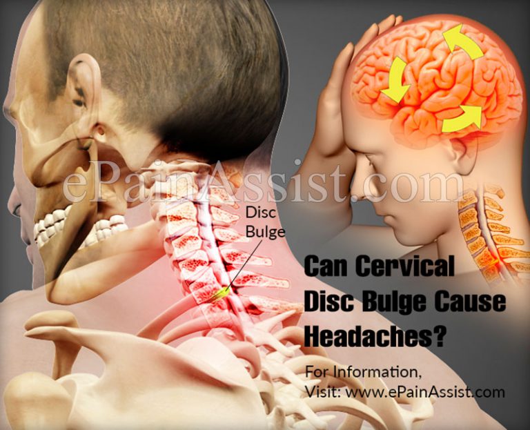 Can Cervical Disc Bulge Cause Headaches?