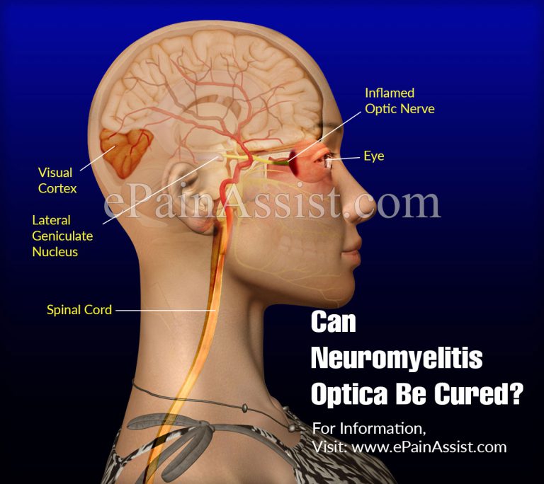 Can Neuromyelitis Optica Be Cured?
