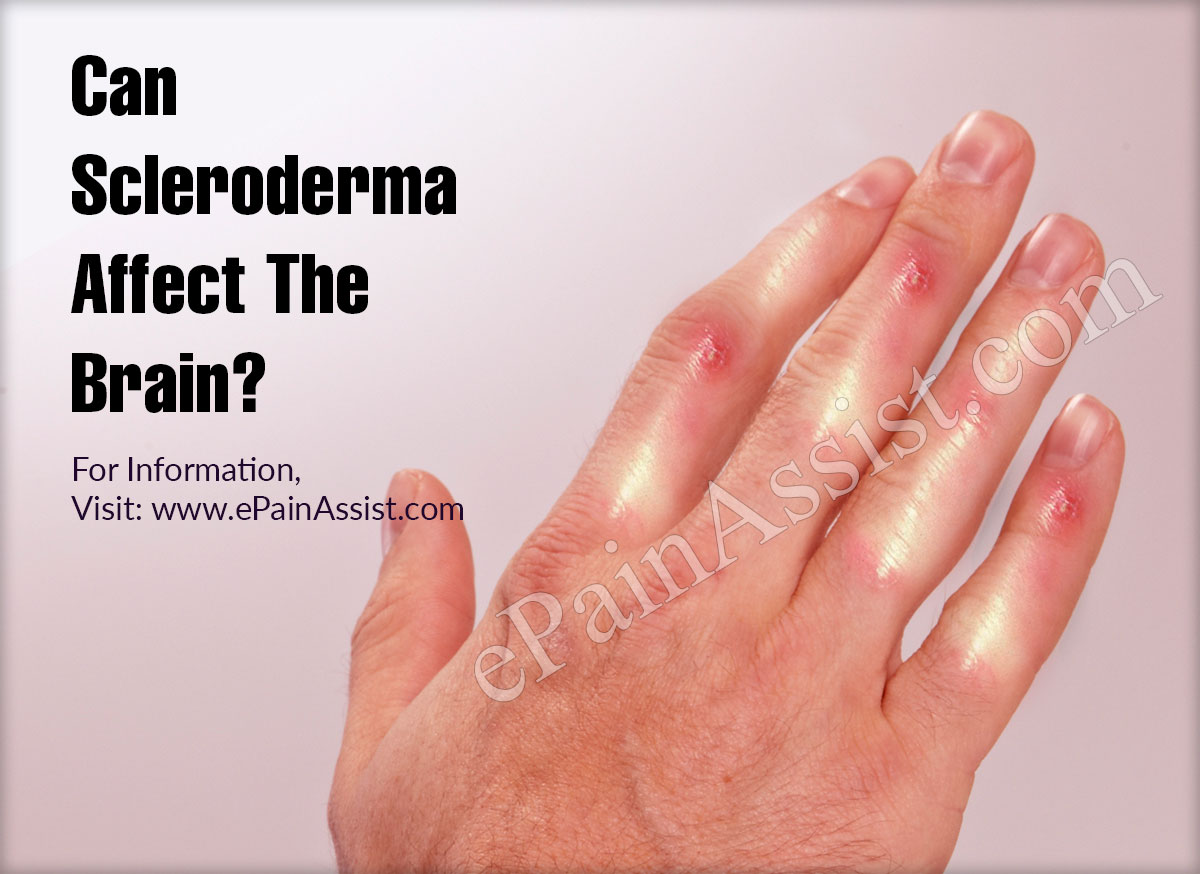 Can Scleroderma Affect The Brain?