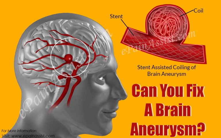 Can You Fix A Brain Aneurysm?