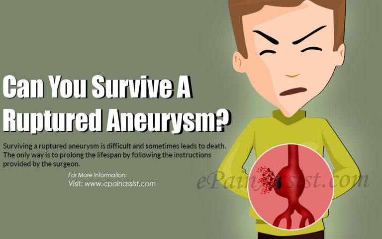 Can You Survive A Ruptured Aneurysm?