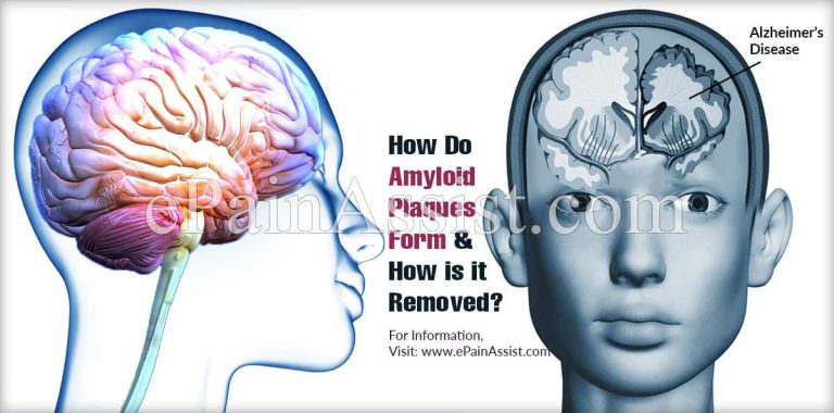 How Do Amyloid Plaques Form & How is it Removed?
