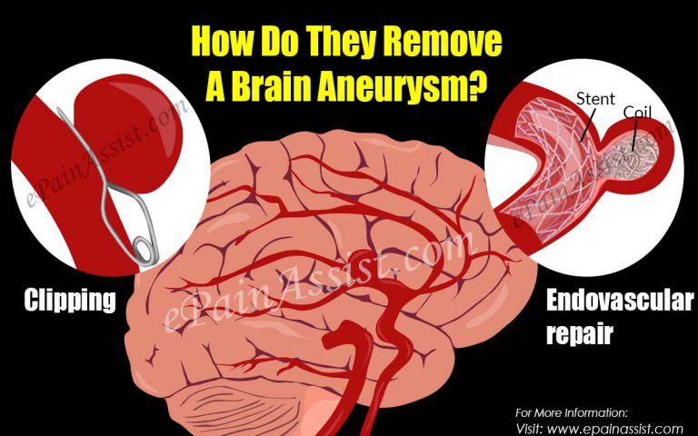 How Do They Remove A Brain Aneurysm?