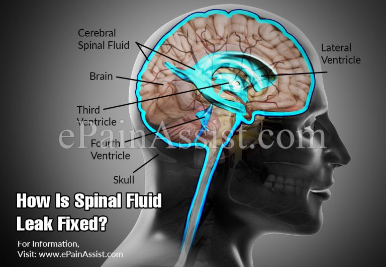 How Is Spinal Fluid Leak Fixed?