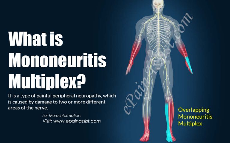 Mononeuritis Multiplex: Causes, Symptoms, Treatment, Prognosis, Risk Factors, Complications, Safety Measures