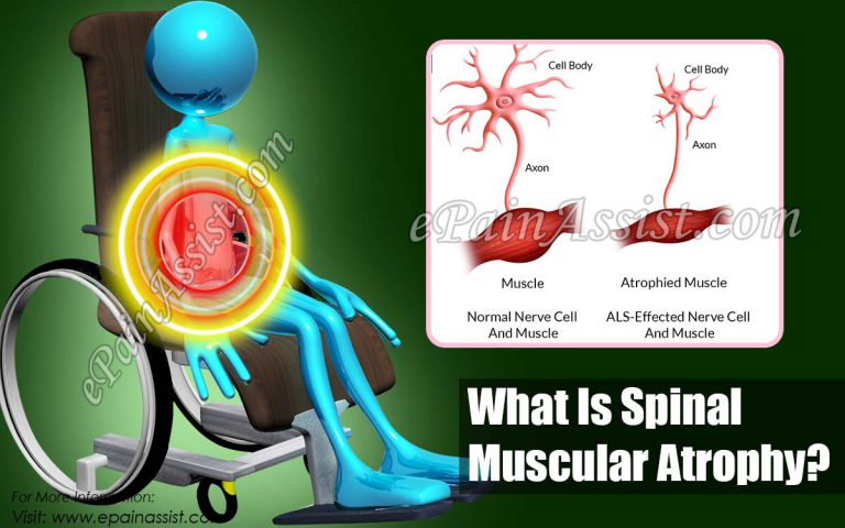 Spinal Muscular Atrophy: Types, Causes, Symptoms, Treatment, Prognosis