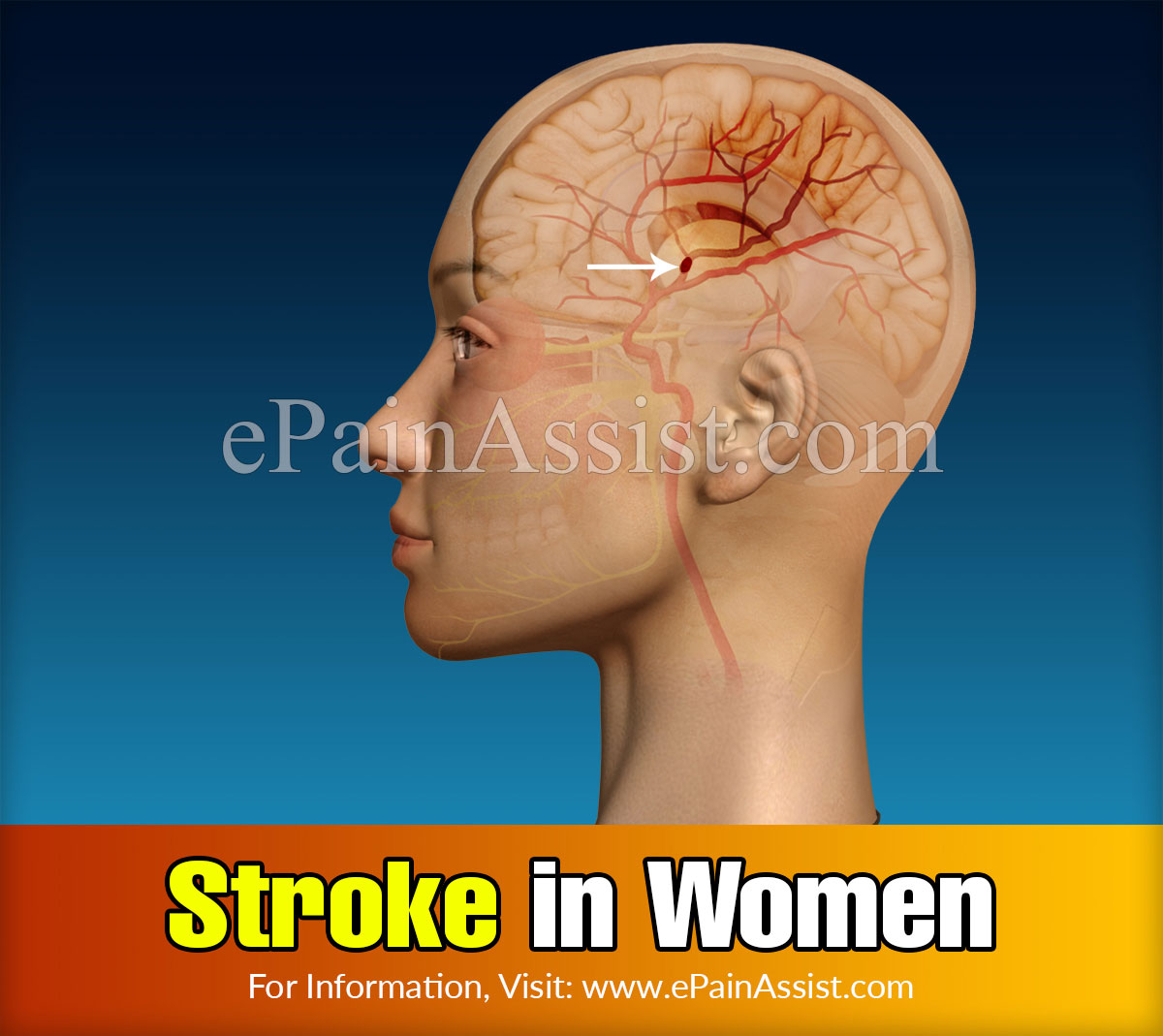 Stroke in Women