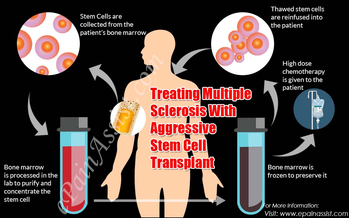 Treating Multiple Sclerosis With Aggressive Stem Cell Transplant