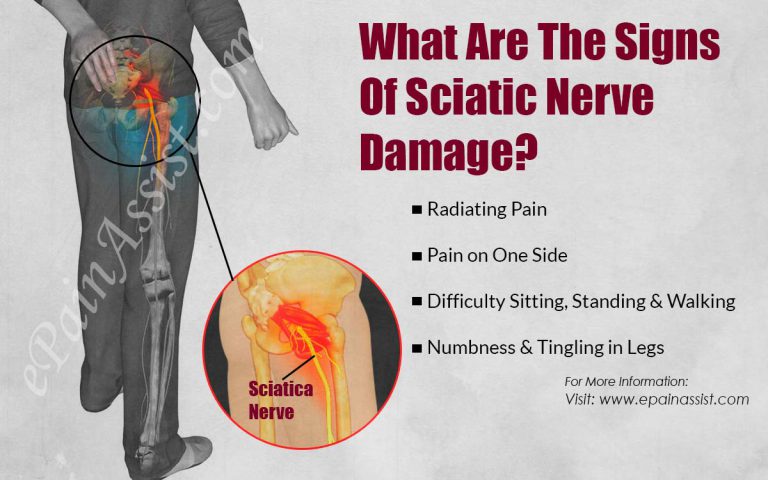 What Are The Signs Of Sciatic Nerve Damage?