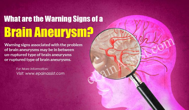 What are the Warning Signs of a Brain Aneurysm?