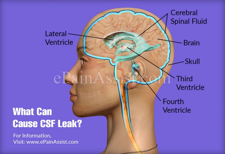 What Can Cause CSF Leak & Is a CSF Leak Serious?