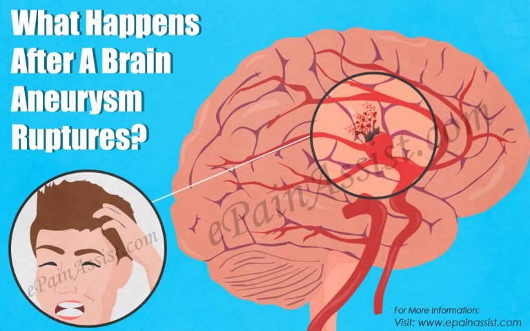 What Happens After A Brain Aneurysm Ruptures?