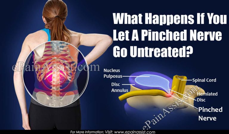 What Happens If You Let A Pinched Nerve Go Untreated?