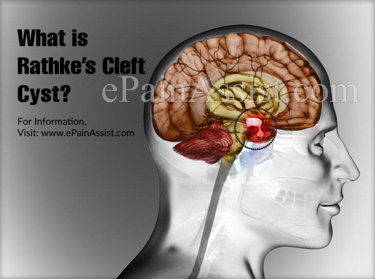 What is Rathke’s Cleft Cyst: Signs, Symptoms, Treatment, Diagnosis