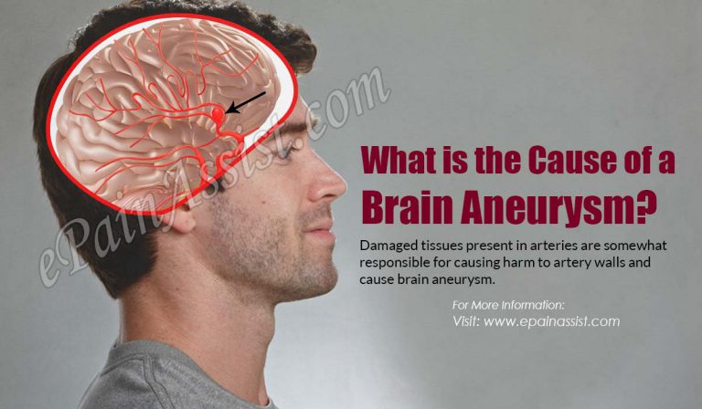 What is the Cause of a Brain Aneurysm?