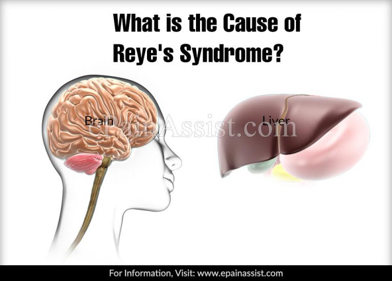 What is the Cause of Reye’s Syndrome?