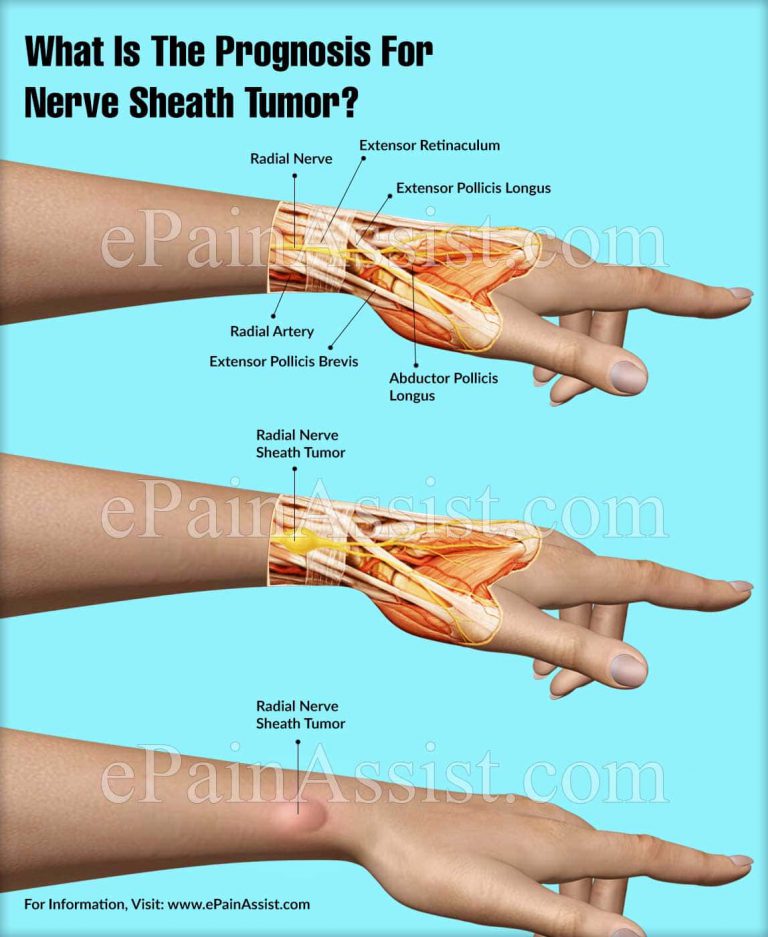 What Is The Prognosis For Nerve Sheath Tumor?