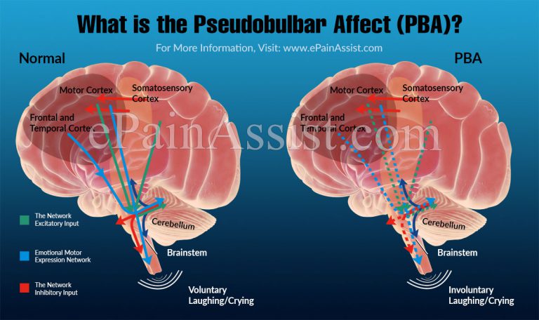 What is the Pseudobulbar Affect (PBA) & How is it Treated?|Connection Between Pseudobulbar Affect (PBA) and MS