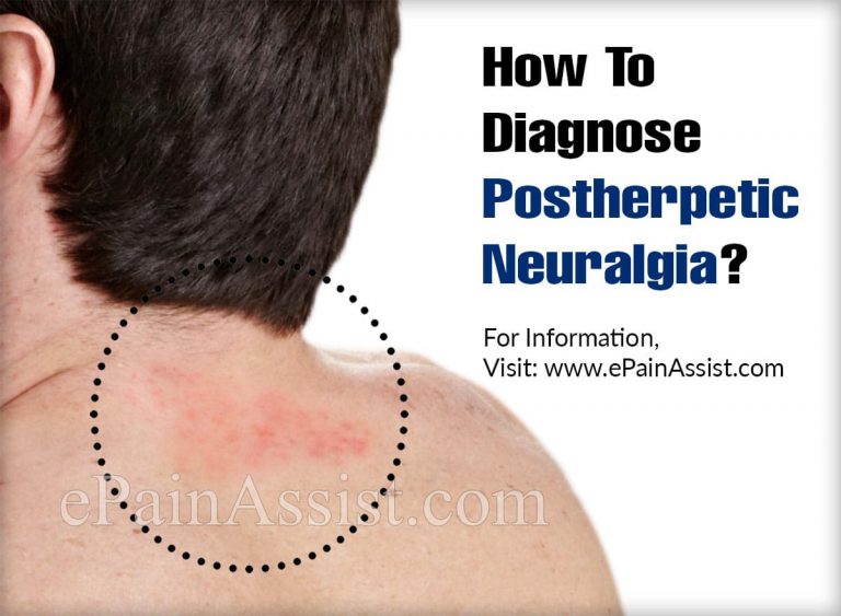 How To Diagnose Postherpetic Neuralgia & What Is The Best Medicine For It?