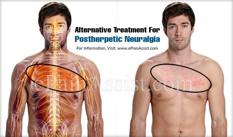 Alternative Treatment For Postherpetic Neuralgia & Is It A Progressive Disease?