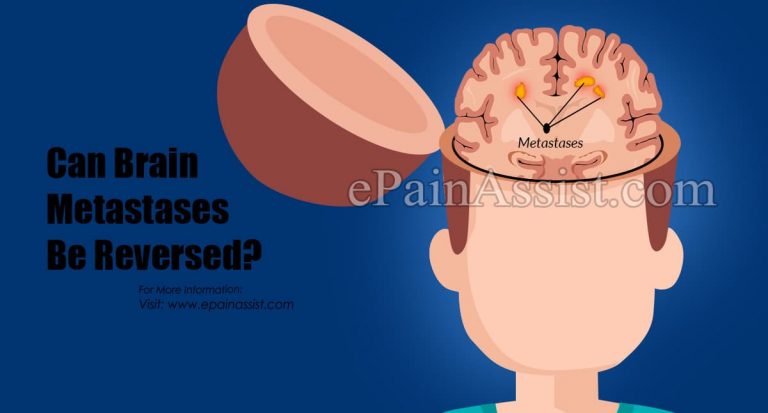 Can Brain Metastases Be Reversed?