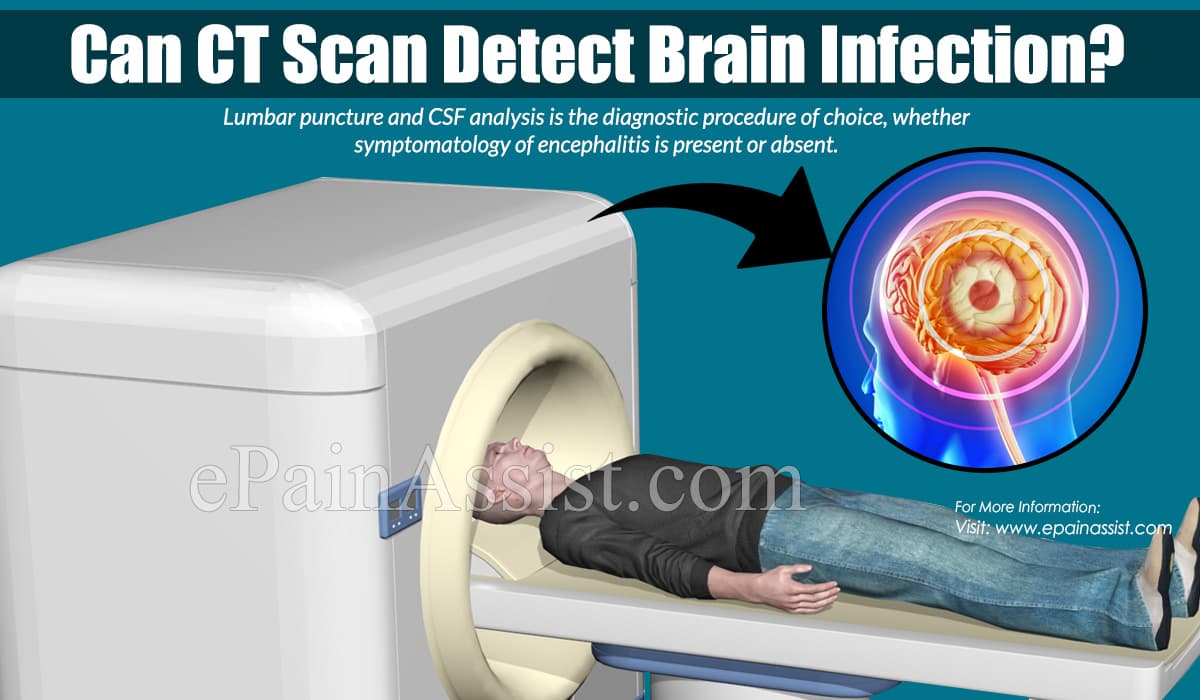 Can CT Scan Detect Brain Infection?