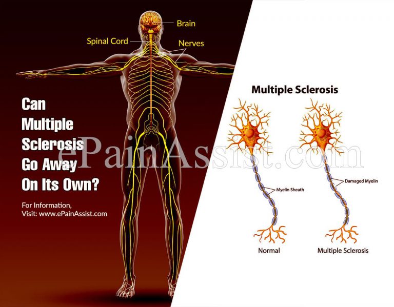 Can Multiple Sclerosis Go Away On Its Own?