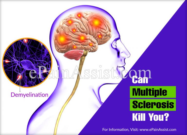 Can Multiple Sclerosis Kill You?