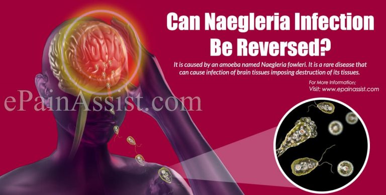 Can Naegleria Infection Be Reversed?