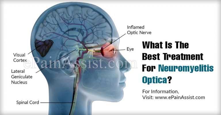 What Is The Best Treatment For Neuromyelitis Optica?