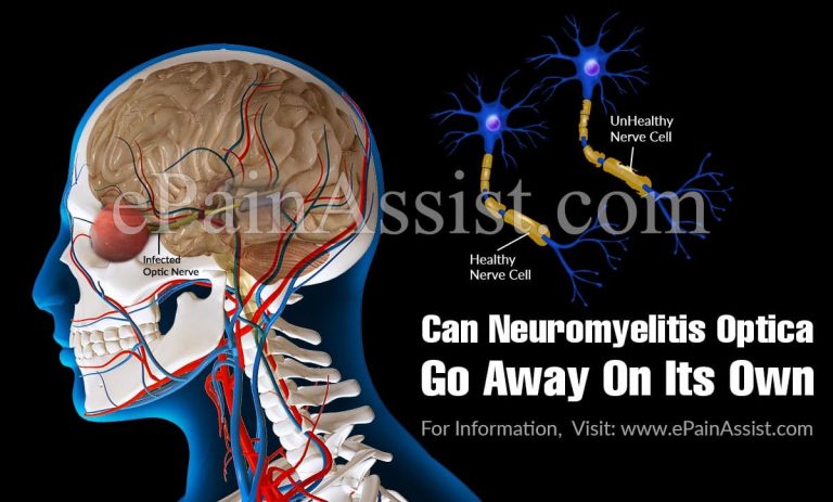 Can Neuromyelitis Optica Go Away On Its Own & What Are It’s Natural Remedies?